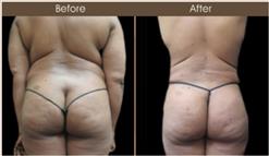 Gluteal Fat Transfer Treatment Before And After